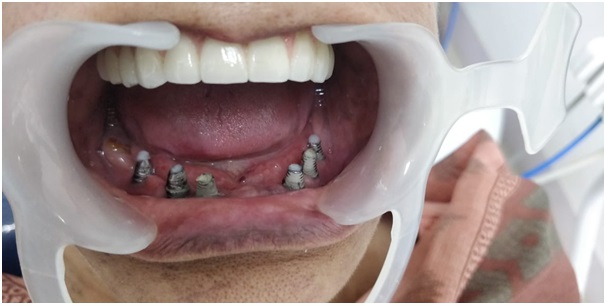 dental implant